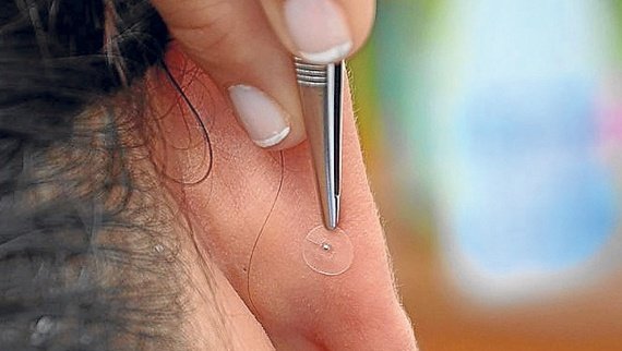 Profesional colocando microesfera de metal en oreja