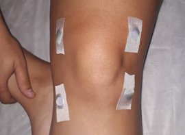 Imanes pegados en rodilla de paciente.